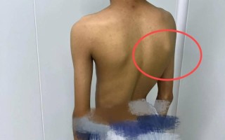 儿童后背脊柱突出图片是脊柱侧弯吗？需要警惕哪些异常信号？