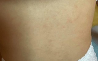 儿童出疹子有哪些常见症状？不同皮疹图片如何区分？
