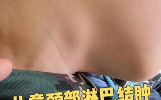 儿童淋巴结长期不消，是严重问题吗？