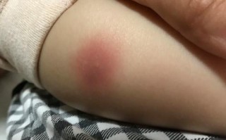 孩子腿上红疙瘩痒怎么办？