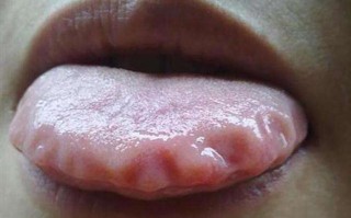 孕期舌头边缘锯齿状是缺锌还是脾虚？孕期舌头边缘锯齿状需要警惕哪些健康问题？