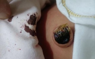 新生儿十天脐带渗血正常吗？需要处理吗？
