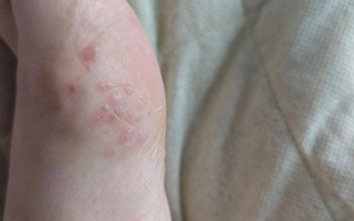 孕期脚丫莫名起泡是缺营养还是生病了？孕妈该如何应对才安全？