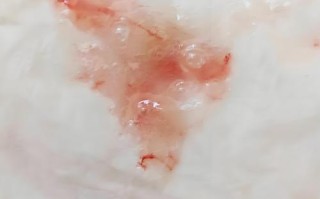 孕期吐痰带血是身体危险信号吗？需警惕哪些孕期并发症？