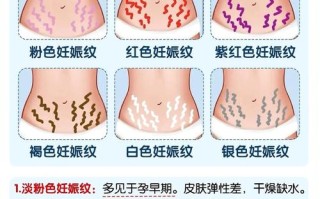 孕期长妊娠纹怎么办？