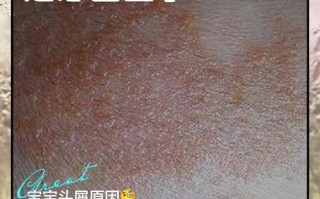 儿童头上有头皮屑，是啥原因引起的？