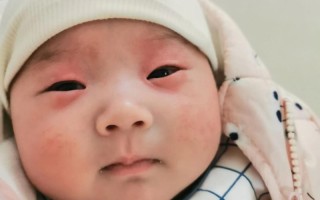 新生儿出生后眼皮肿多久能消肿？正常情况下需要几天？