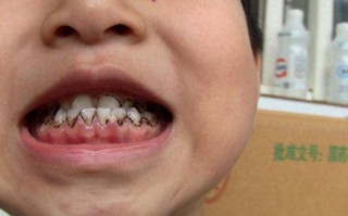 3岁儿童牙齿发黑烂掉，是蛀牙还是其他问题？家长该如何应对？