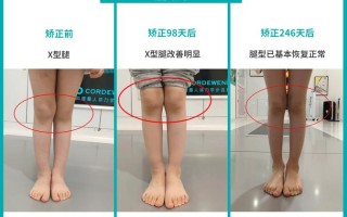 儿童腿型矫正的黄金年龄是几岁？错过会影响发育吗？