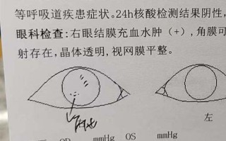 怀孕期间能戴隐形眼镜吗
