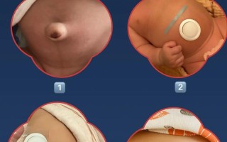 新生儿肚脐鼓出来是怎么回事