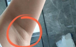 孕期左腋下淋巴结肿大，是孕期正常生理变化还是异常信号？