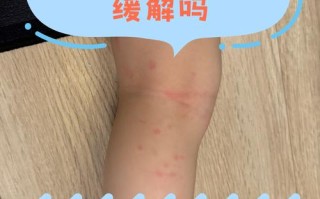 备孕期间服用扑尔敏会影响胎儿健康吗？