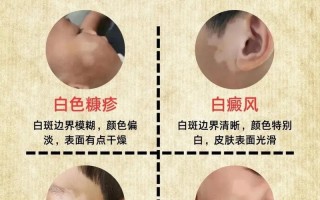 儿童脸上有白斑是缺微量元素还是其他健康问题？