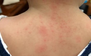 儿童身上起红疙瘩却不痒，是哪些原因导致的？