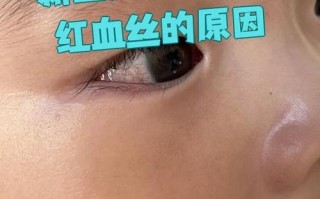 新生儿眼白有血丝是何原因？