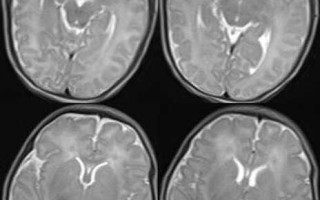 新生儿胆红素脑病早期临床表现