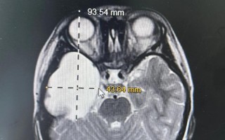 新生儿脑部蛛网膜囊肿会自行消失吗？需要治疗吗？对发育有影响吗？