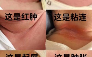 母体链球菌感染新生儿危害有多大？