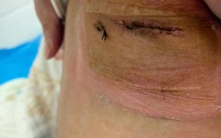 新生儿膈疝手术后会有哪些后遗症？家长该如何应对和护理？