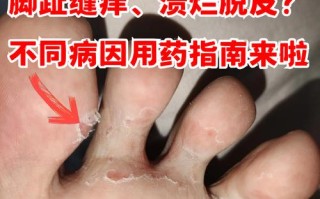 孕期脚气脚趾缝痒，怎么办？