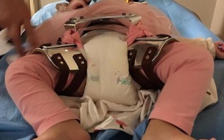 儿童髋关节发育不良有哪些典型症状？