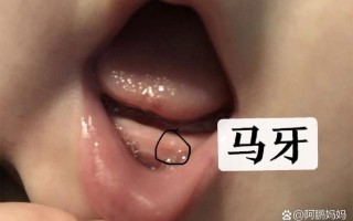 新生儿牙龈上的白东西是什么