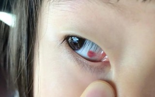 新生儿眼睛里的红血条是正常现象还是疾病信号？需要干预吗？