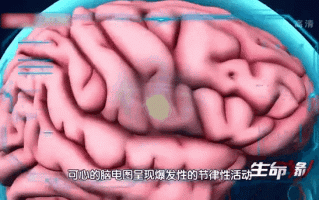 儿童做动态脑电图图片时，家长需要注意哪些事项？