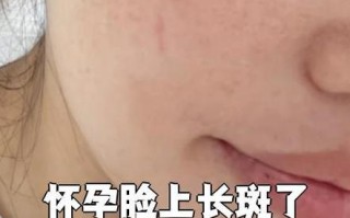 孕期脸长斑是激素还是营养问题？