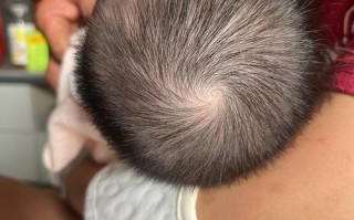 新生儿的头被打了一下