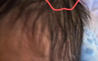 新生儿头上软包多久能自行吸收？