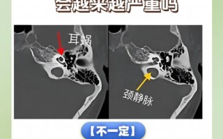 儿童颈部静脉窦是否存在？正常情况下需要关注吗？