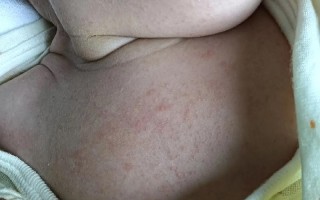 新生儿打乙肝疫苗会有哪些反应？