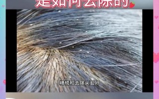 怀孕期间头上长虱子怎么办