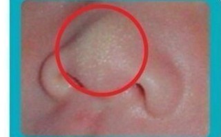 新生儿鼻尖上长小白点是什么