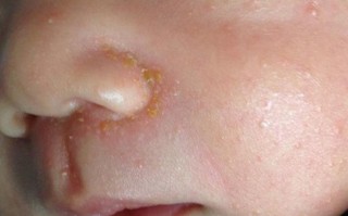 新生儿鼻子黄点点是啥？