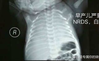 新生儿照X光会影响健康吗？