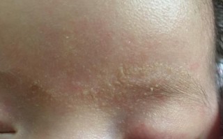 新生儿眉毛上长红疙瘩是湿疹还是过敏？该怎么护理才好？