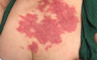 新生儿身上的红胎记会自行消退吗？消失过程需要多久？