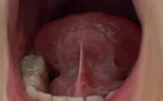 儿童舌系带短手术费用是多少？