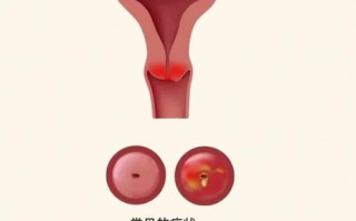 孕期附件炎症状是什么