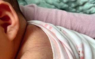 新生儿后背胎毛图片是正常现象吗？需要处理吗？