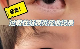 儿童过敏性结膜炎究竟多久能好？