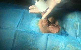 儿童环切手术后脱落过程会持续多久？脱落期间需要如何护理？