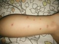 三岁儿童身上突然起红疙瘩，是过敏、湿疹还是其他问题？
