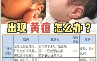 新生儿黄疸260μmol/L算严重吗？需要照蓝光治疗吗？