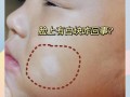 新生儿脸上出现的小白点到底是什么？需要担心吗？
