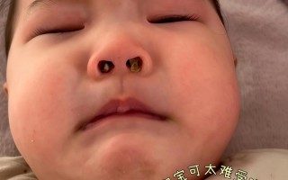 新生儿鼻子中间有条黑线是正常现象吗？需要担心或处理吗？