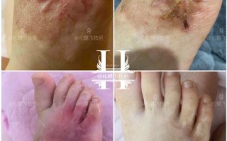 儿童烫伤疤痕修复，哪家医院最好？